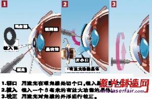 英激光新技術校正老花眼